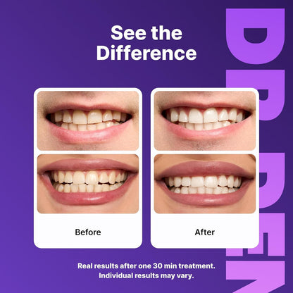 Purple Whitening Strips - Peroxide-Free Whitening For A Brighter Smile