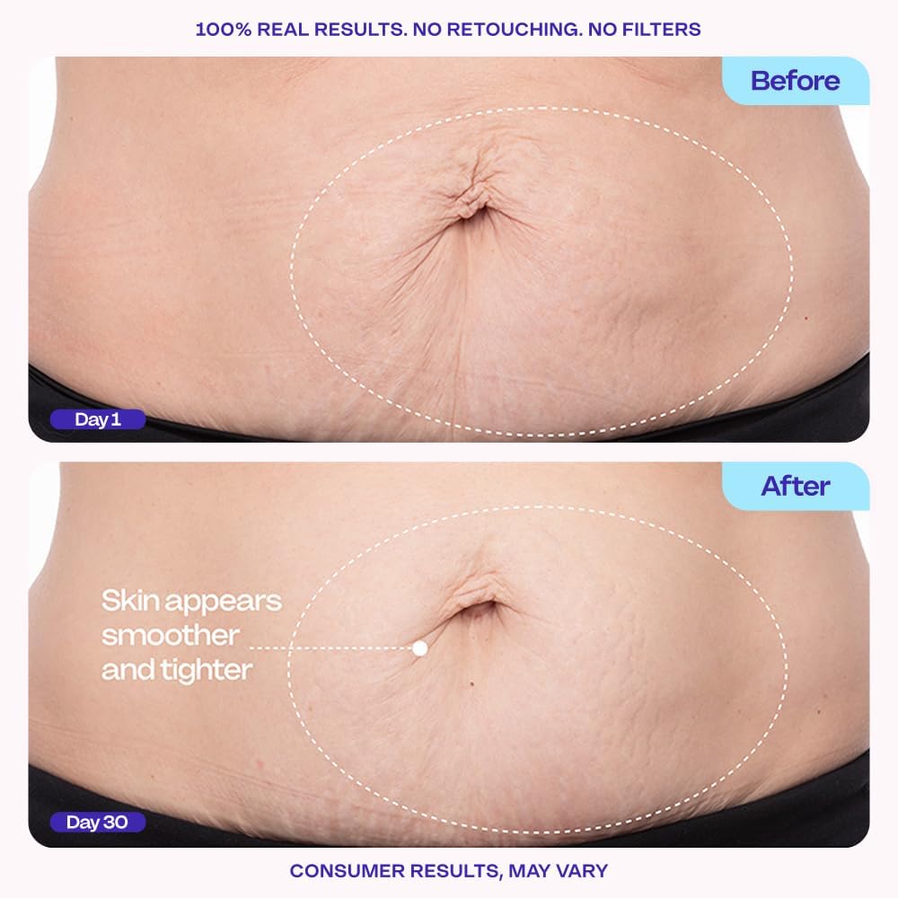 Belly Firming Cream - 6% MicroTight4™ Complex For Smoother, Firmer-Looking Skin