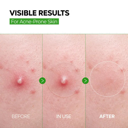 Ultra-Thin Spot Patch Duo - 2-Step Care For Blemishes & Dark Spots